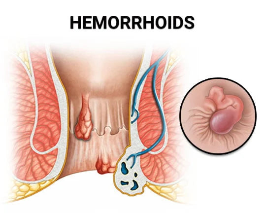 Crema Tratamiento Hemorroides - Alivio Inmediato, Tratamiento Avanzado para el Malestar y la Inflamación