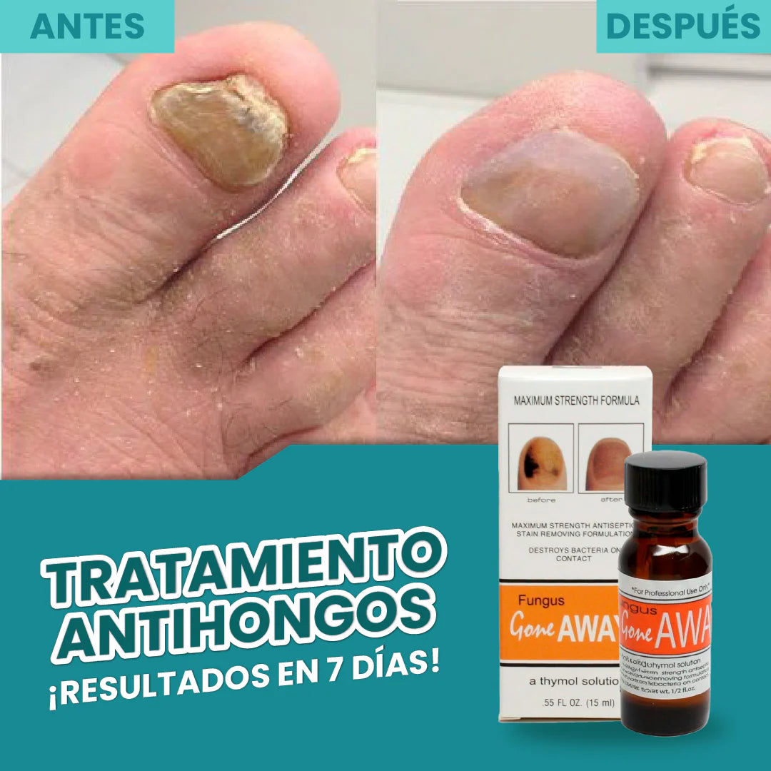 Tratamiento Antifúngico Pro – ¡Recupera la Salud y Belleza de tus Uñas Ya!